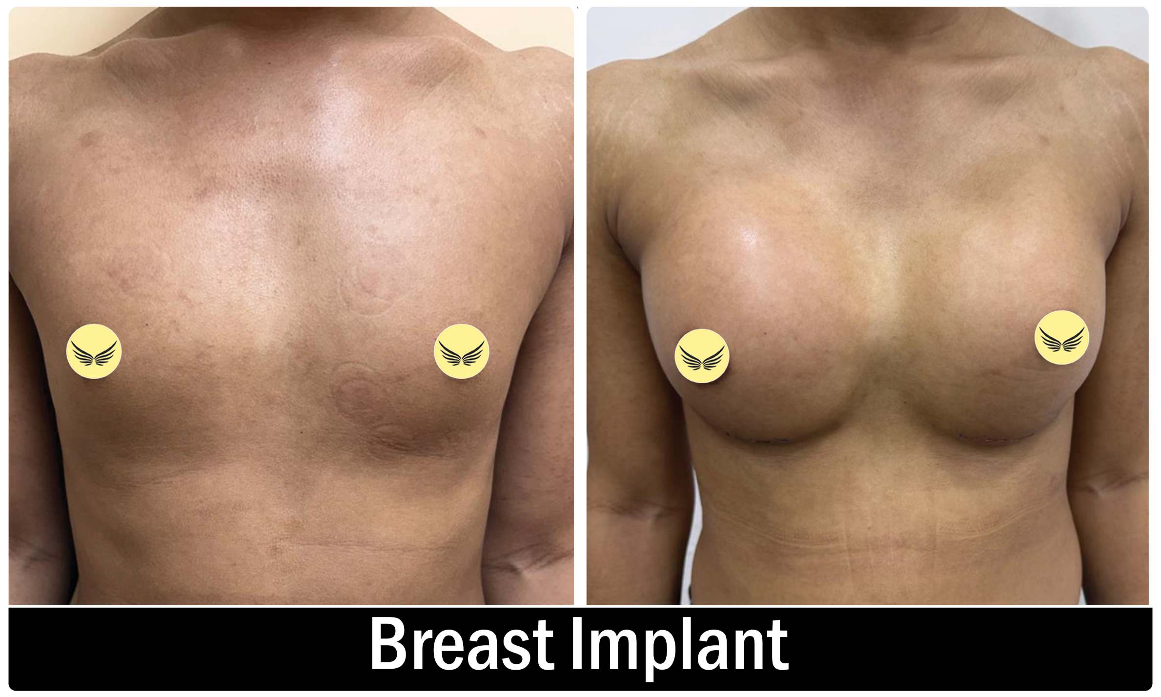 Breast Implant KOQ10